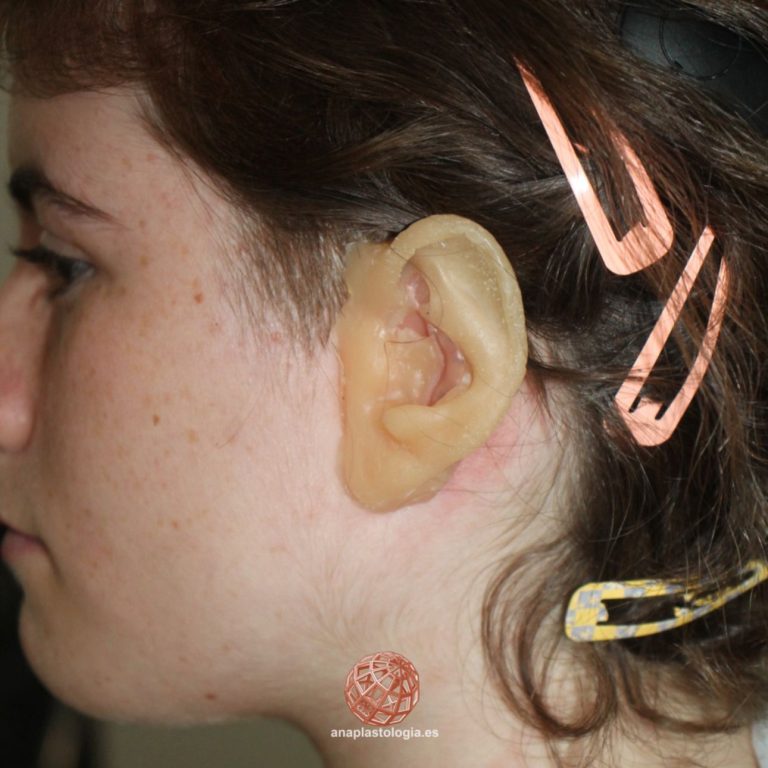 Prótesis auricular sobre implantes colocada en paciente joven