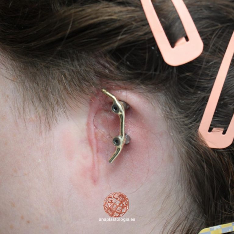 Barra de implantes para sujetar la prótesis auricular