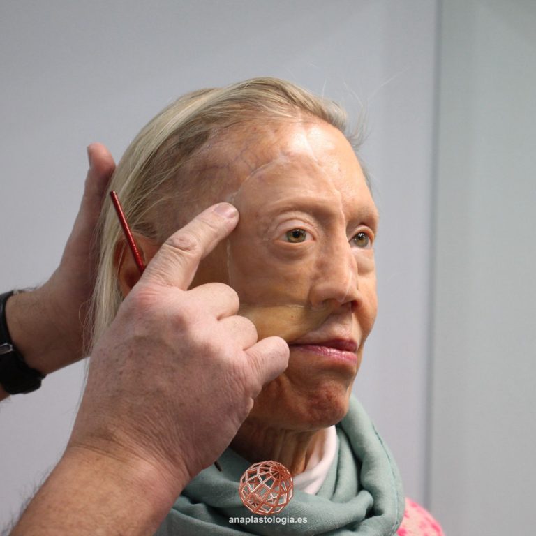 Prueba de prótesis hemifacial en la paciente