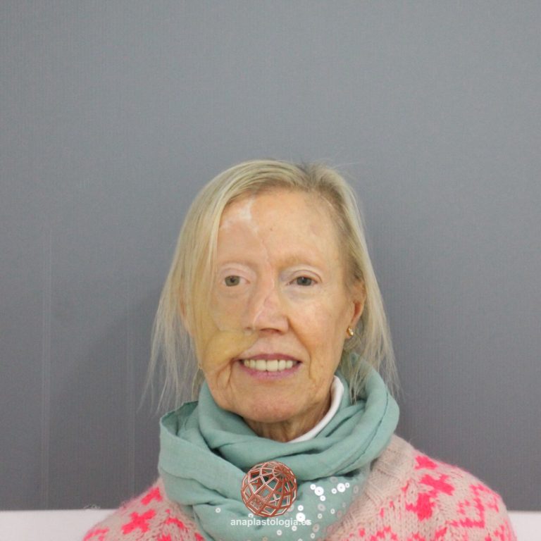 Resultado de prótesis hemifacial en mujer, vista frontal