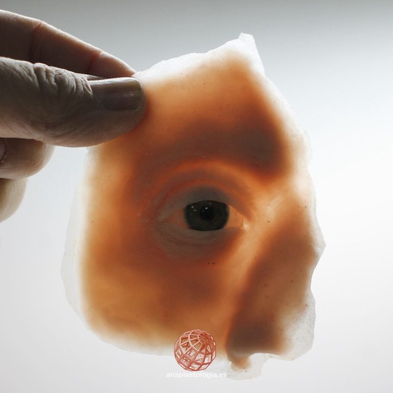 Prótesis hemifacial de silicona translúcida con ojo