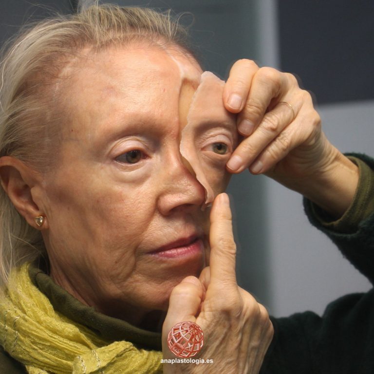 Paciente colocándose su prótesis hemifacial